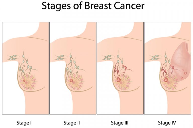 乳癌初期存活率-分期特徵-治療方案