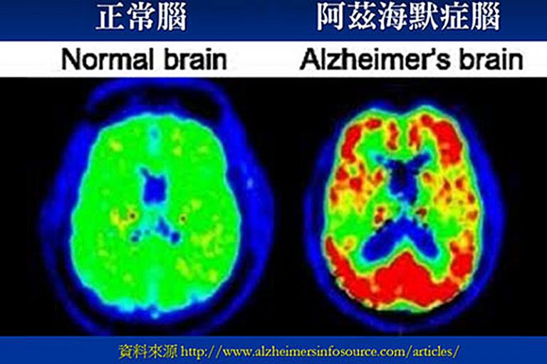 認知障礙症-亞爾茲默氏病-腦袋圖-成因