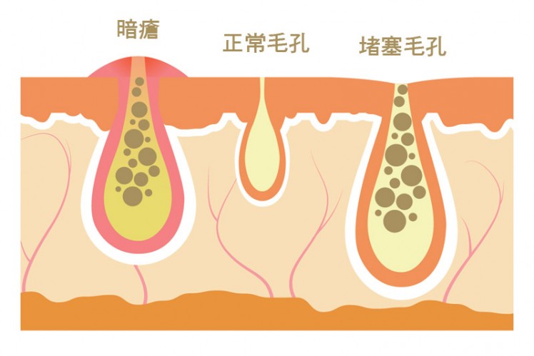暗瘡解決-根治-口服A酸-功效-副作用-皮膚科醫生