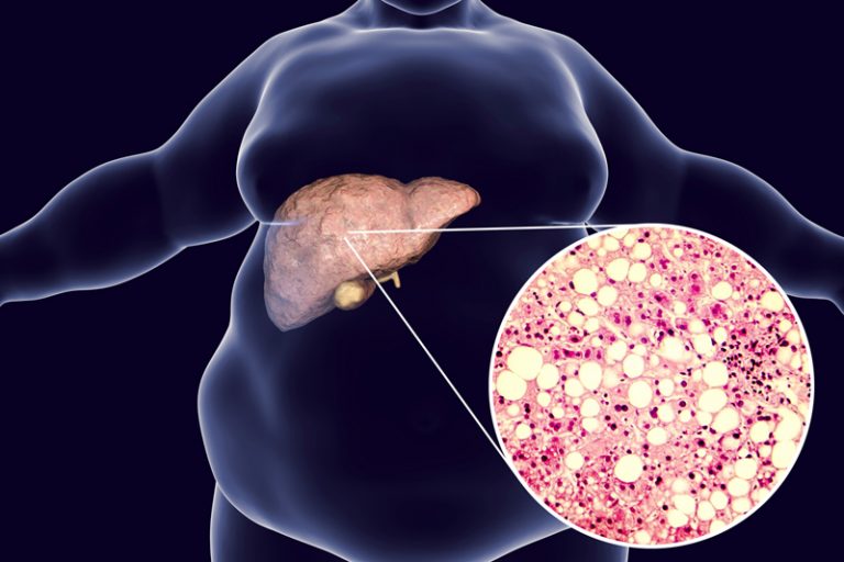 脂肪肝飲食貼士-症狀-診斷-檢查-cancercare