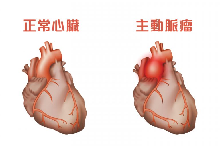 動脈瘤原因-症狀-診斷-心臟專科-陳麒尹醫生