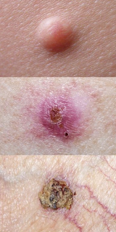 皮膚癌特徵-良性皮膚斑點-身體痣-戴燕萍-臨床腫瘤科專科醫生