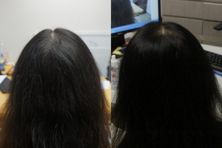 防脫髮-脫髮原因-治療-健髮生髮療程活化毛囊-髮再生