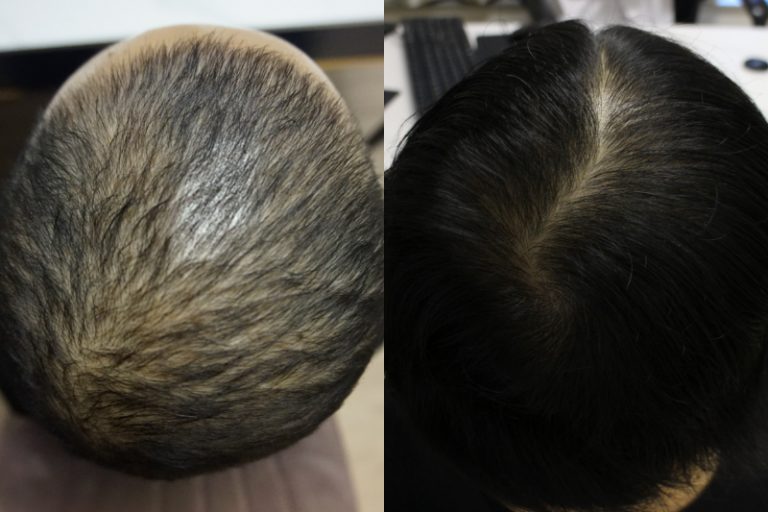 防脫髮-脫髮原因-治療-健髮生髮療程活化毛囊-髮再生